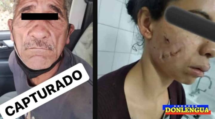 Acosador de 63 años le desfiguró el rostro a una joven de 23 en Los Teques