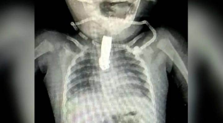 Bebé de 8 meses se tragó un cortaúñas y le quedó atrapado en la garganta